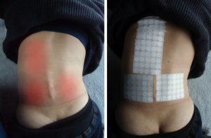 側弯症でやってはいけないことは?原因は腰方形筋の左右差だった 8