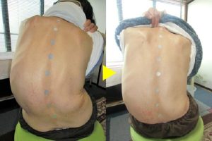 側弯症でやってはいけないことは?原因は腰方形筋の左右差だった 11