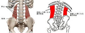 側弯症でやってはいけないことは?原因は腰方形筋の左右差だった 6