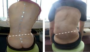 側弯症でやってはいけないことは?原因は腰方形筋の左右差だった 3