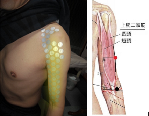 二の腕の内側が痛い原因
