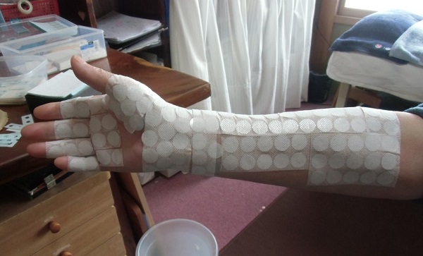 手首をひねると痛いの治療事例