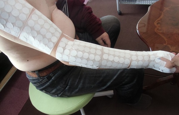 手首が痛い親指側の治療事例