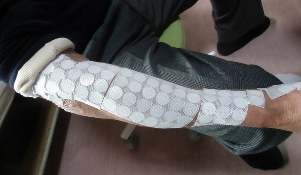 腕と肘が痛いの治療例➀