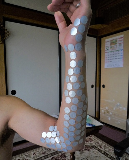 手首が痛い小指側の治療事例