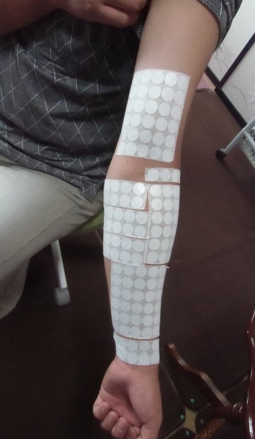 肘をひねると痛いの治療例