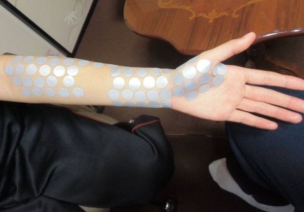 手首を曲げると痛いの治療事例