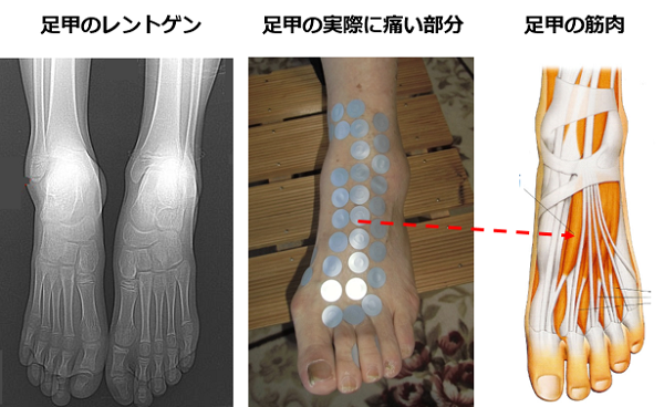 レントゲンに写らない足甲の痛みの原因