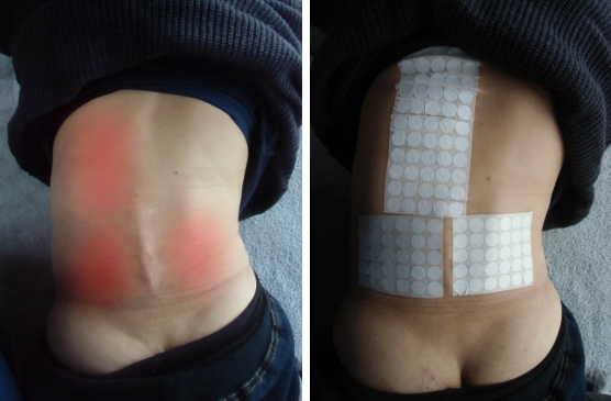 側湾症の施術方法解説