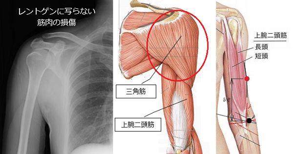 肩が痛くて腕が上がらない原因