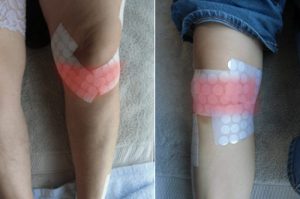 膝の皿の下が痛い原因は膝蓋腱にあった!ジャンパー膝・オズグッド病のセルフケアと改善トレーニング完全ガイド 5