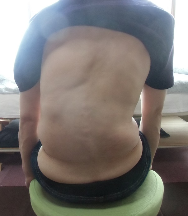 骨盤の歪みと側湾症