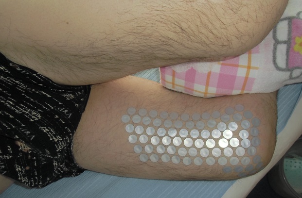 膝の内側が痛い原因を確認した写真