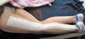 太もも裏が痛い原因は大腿二頭筋?坐骨神経痛との見分け方と治し方 4