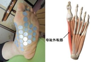 足裏 痛い 原因を徹底解説 歩くと痛む足の裏の主な病気とセルフチェック法 今すぐできる対処法と受診の目安まで完全ガイド 6
